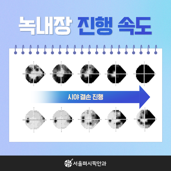 서울퍼시픽안과_44차_일러스트카드뉴스(녹내장진행속도)02.jpg